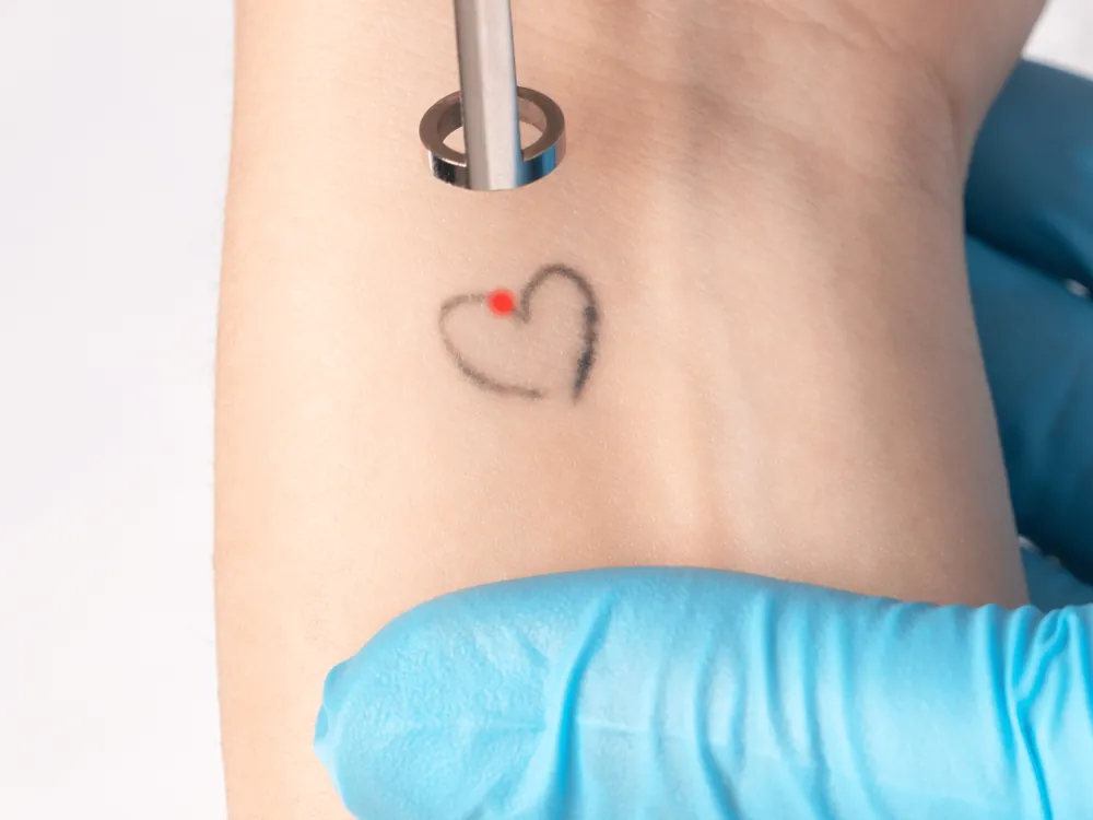 Séance de détatouage au laser sur un petit tatouage