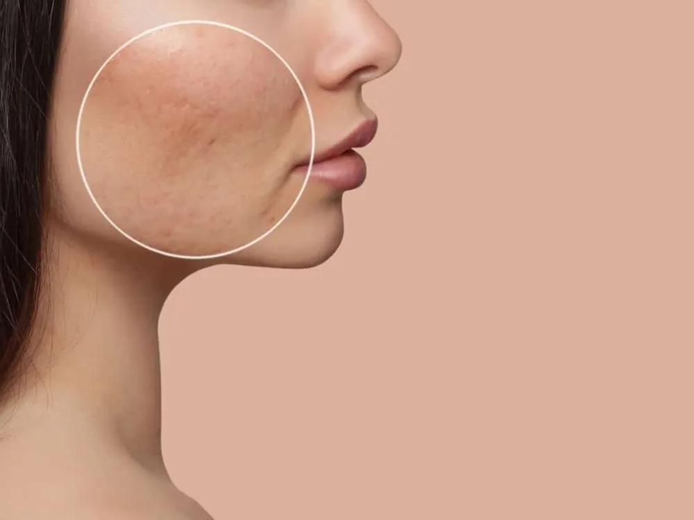 Joue avec des cicatrices d'acné cerclées, profil d'une jeune femme