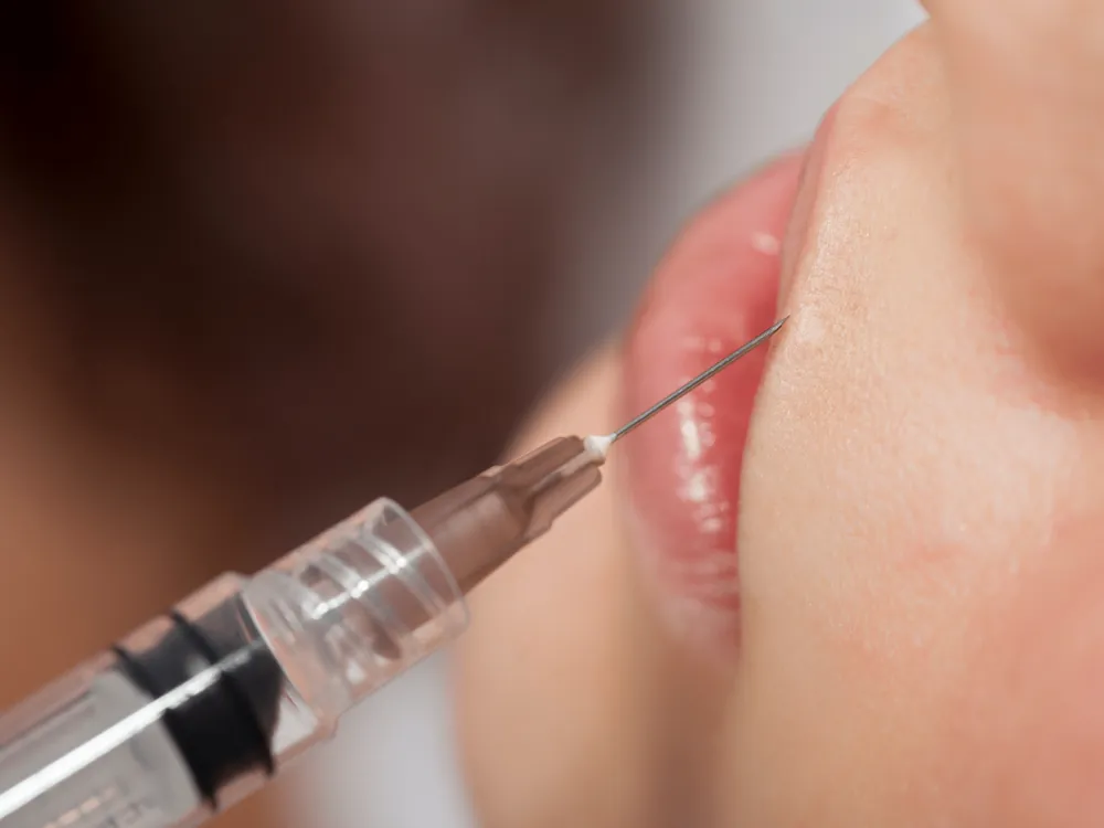 Injection d'acide hyaluronique des lèvres chez My Laser