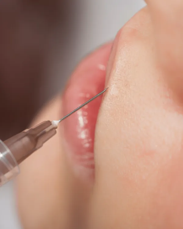 Injection d'acide hyaluronique des lèvres chez My Laser