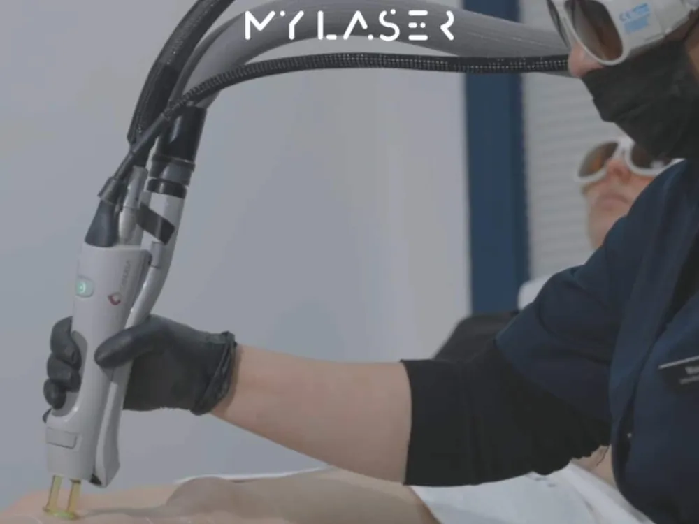 Pièce à main du laser tenue par une praticienne gantée au centre My Laser Casablanca