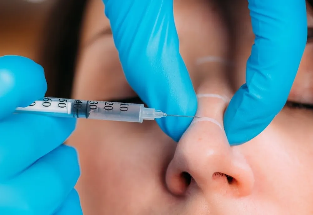 Profil au nez droit et harmonieux après une rhinoplastie médicale chez My Laser Maroc