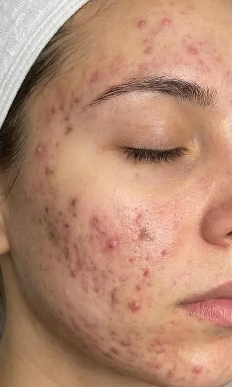Joue avec des lésions d'acné active avant le traitement chez My Laser Casablanca