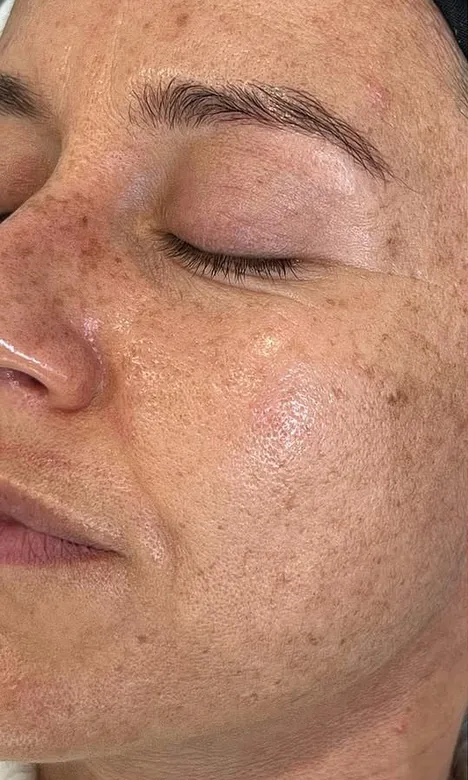 Taches de mélasma sur le visage avant le traitement dépigmentant chez My Laser Casablanca