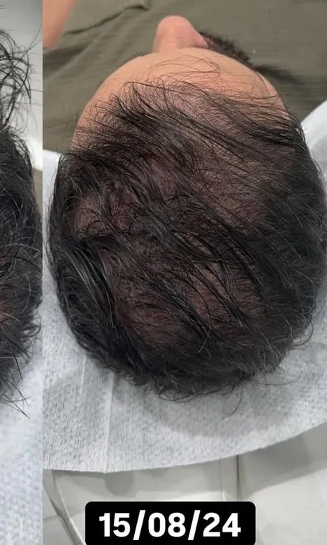 Cheveux plus denses deux mois après le traitement capillaire PRP chez My Laser Casablanca
