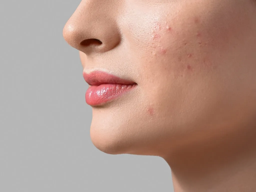 Joue avec des lésions d'acné inflammatoire avant le protocole Blemiderm