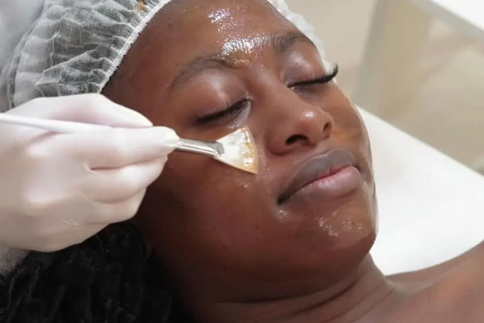 Application du peeling TCA au pinceau sur le visage d'une patiente allongée