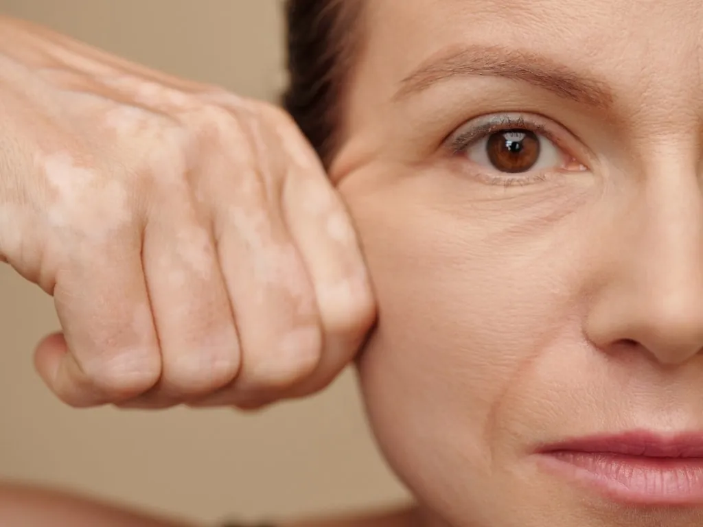 Visage d'une femme en gros plan, la peau du contour de l'œil tendue par la main, relâchement cutané traité par l'Endolift