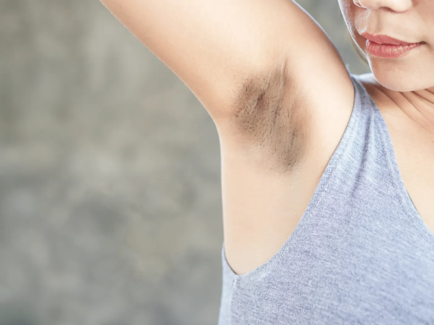 Aisselle hyperpigmentée d'une femme, avant un peeling éclaircissant