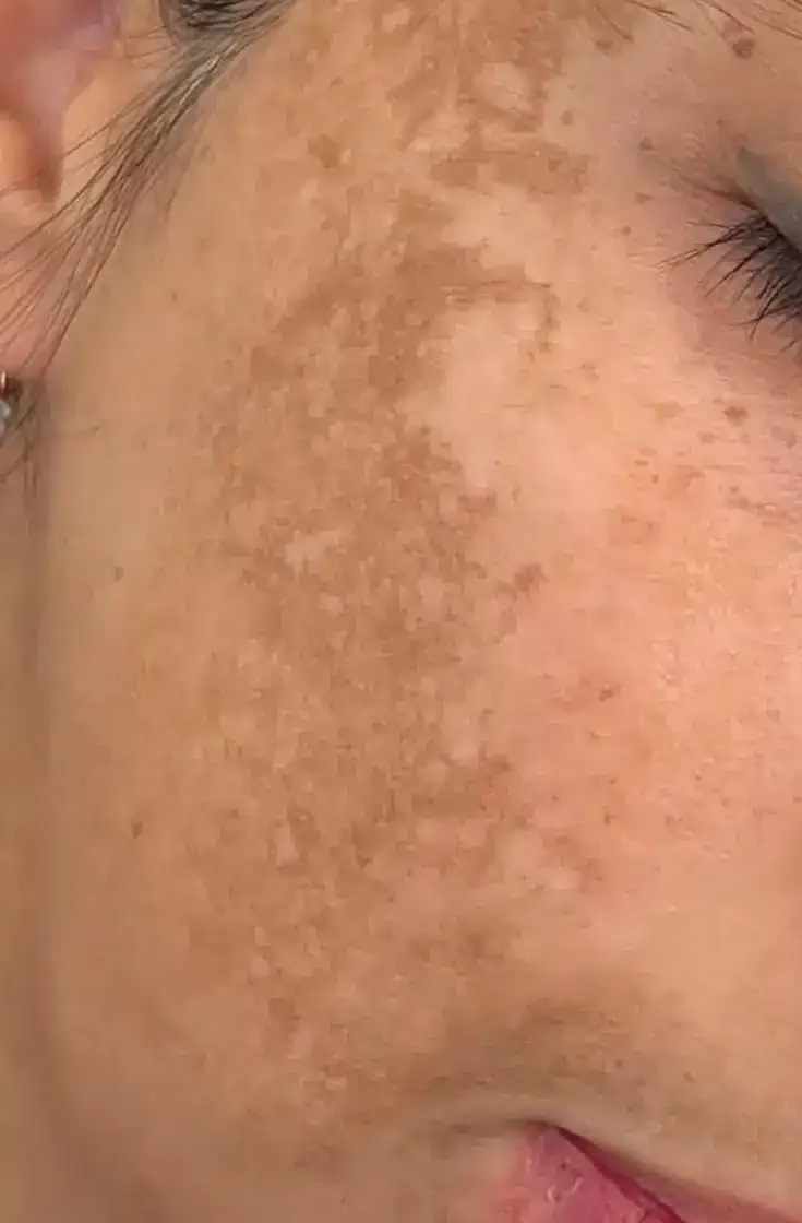 Taches brunes et mélasma sur la joue avant le traitement au laser