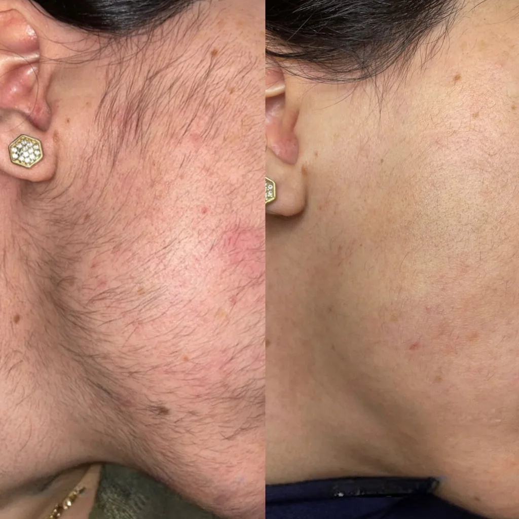 Joue et mâchoire d'une femme avec une pilosité liée au SOPK avant, puis peau nette après électrolyse chez My Laser Casablanca