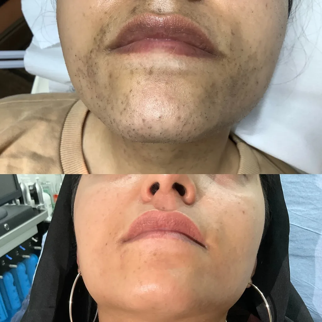Menton d'une femme avec des poils avant, puis menton lisse après électrolyse chez My Laser Casablanca