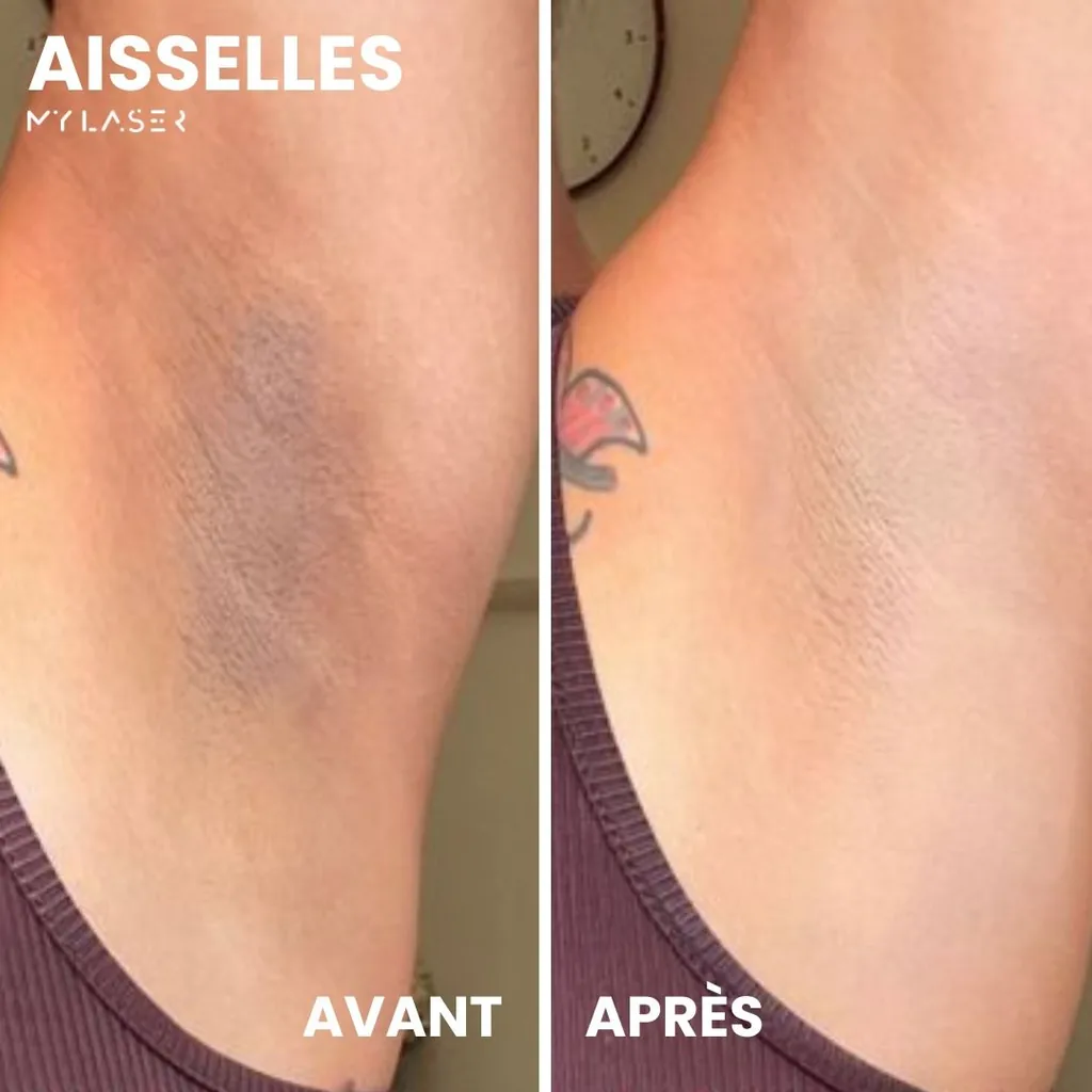 Aisselle avant et après épilation laser chez My Laser Casablanca, ombre de poils sous la peau puis aisselle nette