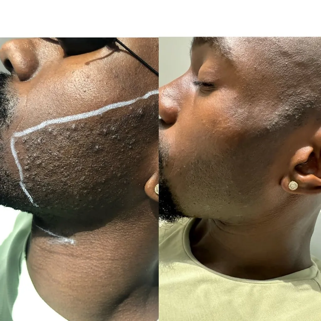 Contour de barbe d'un homme à la peau noire avant et après épilation laser chez My Laser Casablanca, poils incarnés disparus