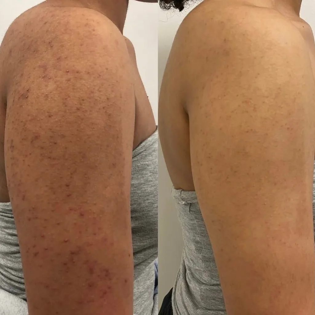Bras d'une femme avec kératose pilaire et poils avant, puis peau lissée après épilation laser chez My Laser Casablanca