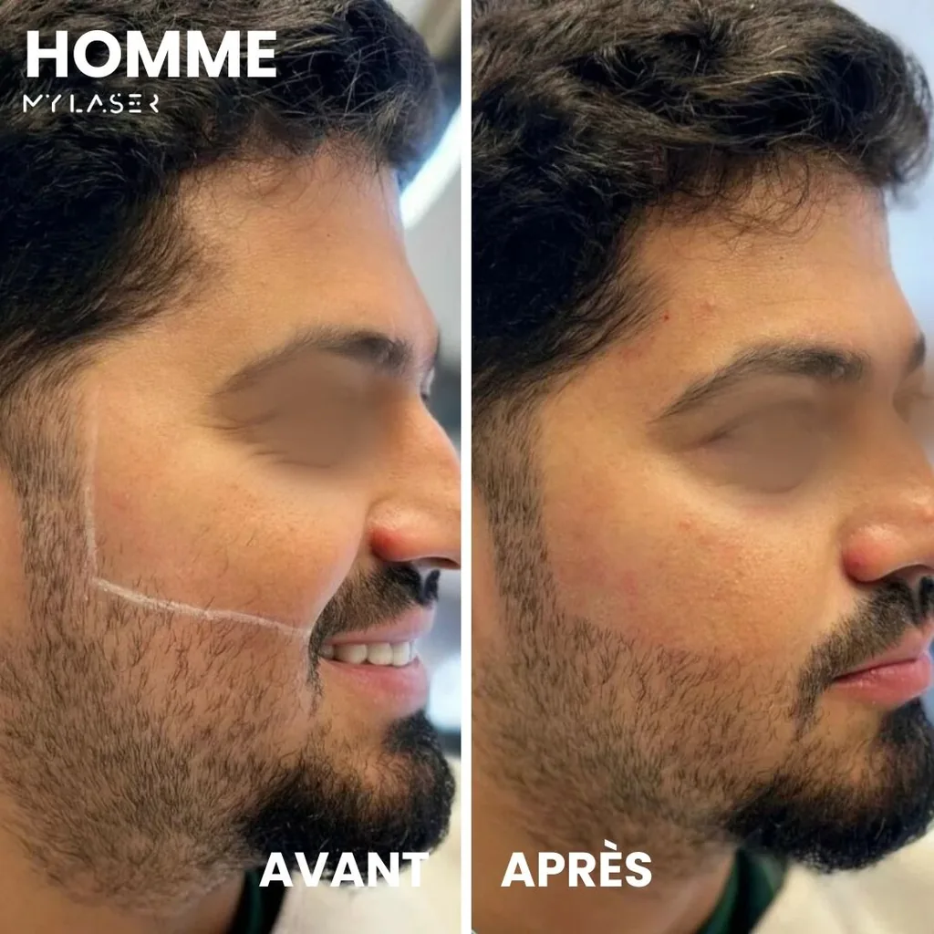 Joue d'un homme avec le tracé du contour de barbe avant, puis ligne de barbe nette après épilation laser chez My Laser Casablanca