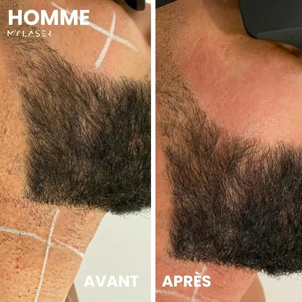 Joue et contour de barbe d'un homme tracés au crayon blanc avant, puis dégagés après épilation laser chez My Laser Casablanca