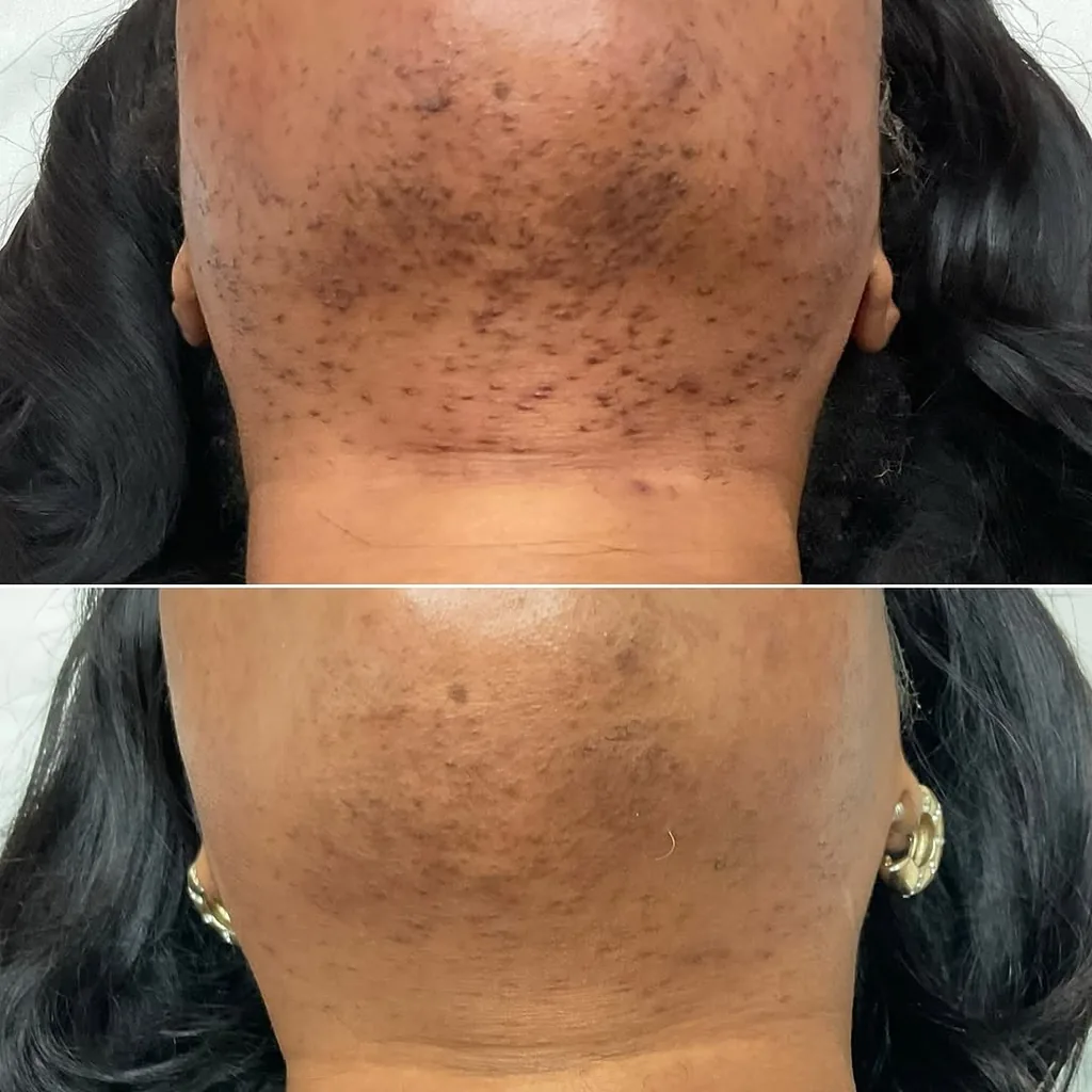 Cou et menton d'une personne à la peau foncée avant et après épilation laser chez My Laser, poils incarnés et taches atténués