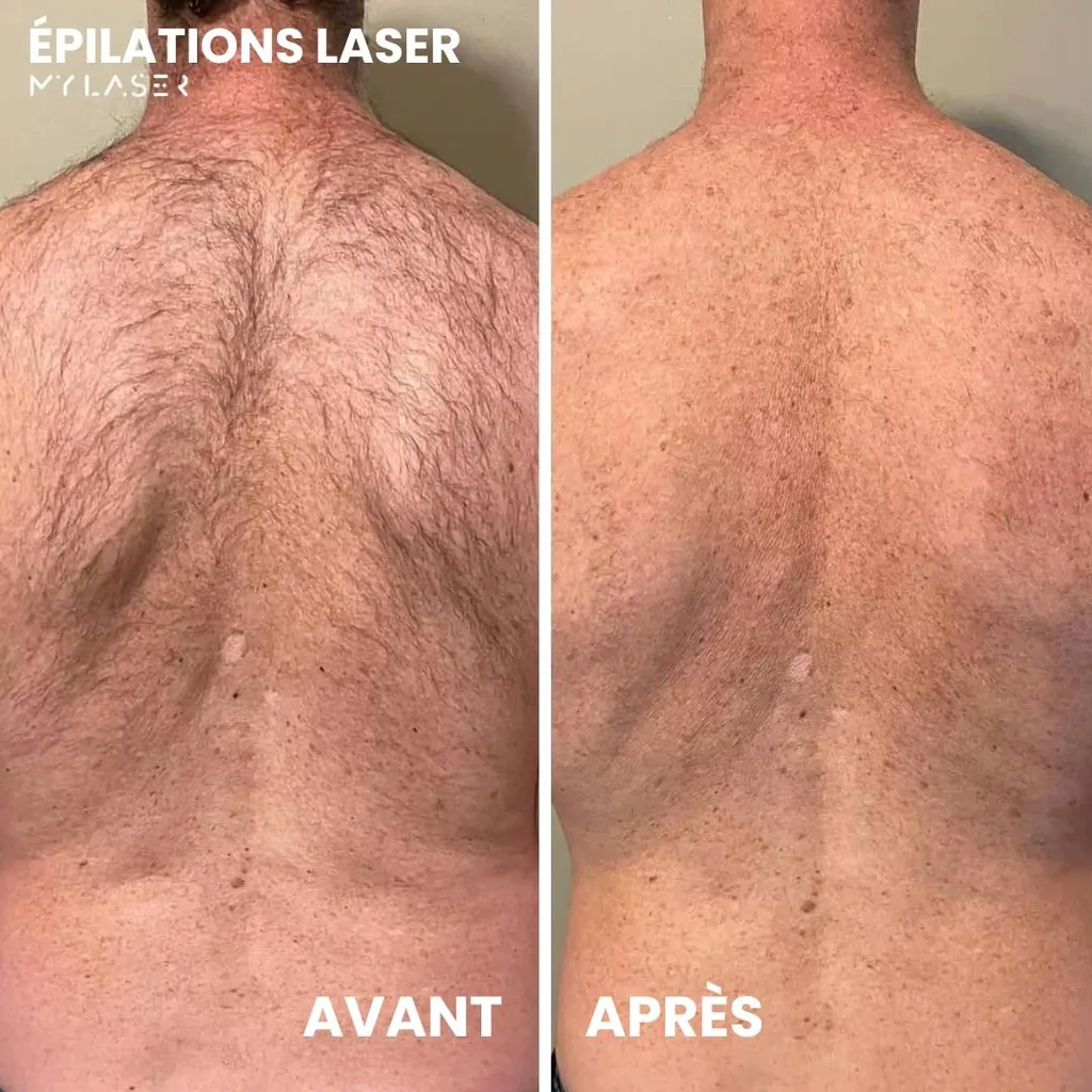 Dos d'un homme avant et après épilation laser chez My Laser Casablanca, pilosité dense puis peau nette