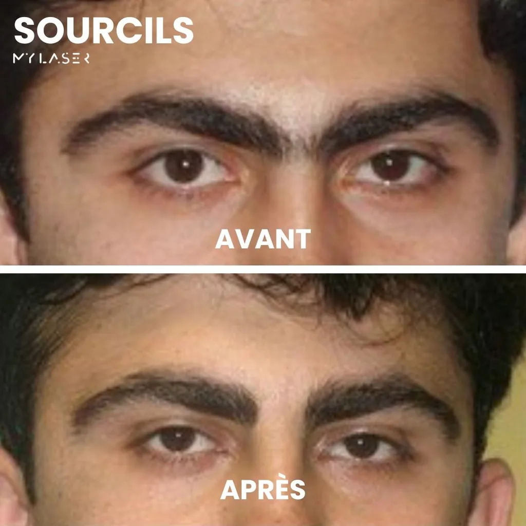 Inter-sourcils d'un homme avant et après épilation laser chez My Laser Casablanca, poils entre les sourcils supprimés