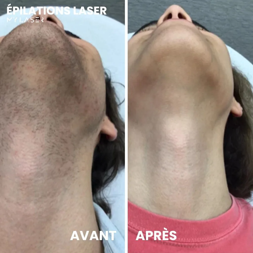 Menton et cou d'une femme avant et après épilation laser chez My Laser Casablanca, poils du menton disparus