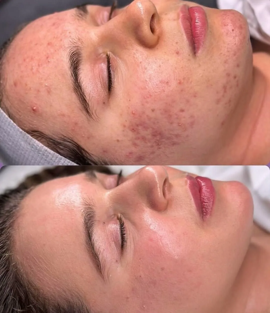 Avant et après du traitement de l'acné active sur le visage d'une femme, lésions puis peau apaisée, My Laser Casablanca