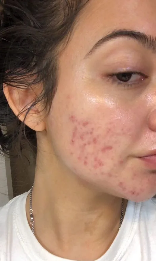 Joue d'une femme avec de l'acné inflammatoire avant le traitement chez My Laser Tanger