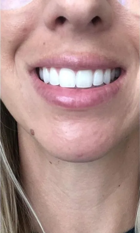 Sourire équilibré après l'injection de toxine botulique chez My Laser