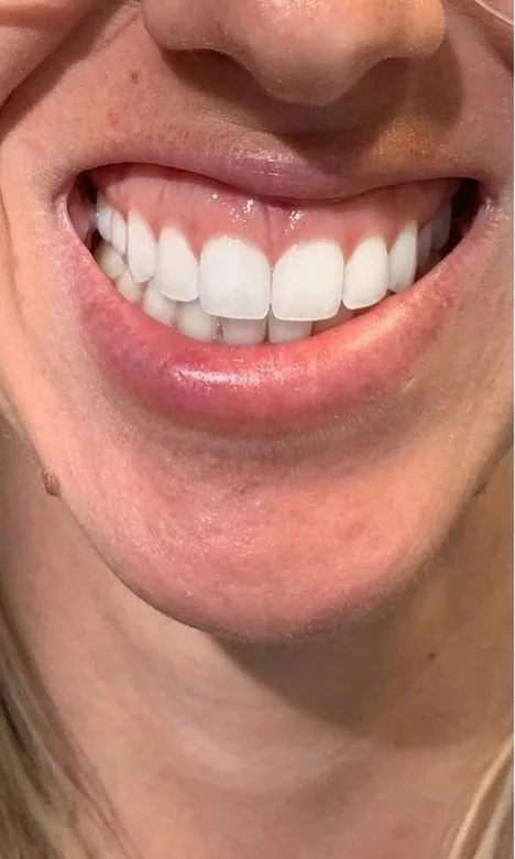 Gencive très visible au sourire avant l'injection de toxine botulique chez My Laser