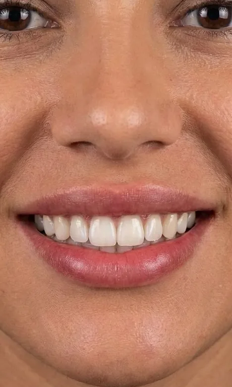 Sourire harmonieux après l'injection de toxine botulique chez My Laser