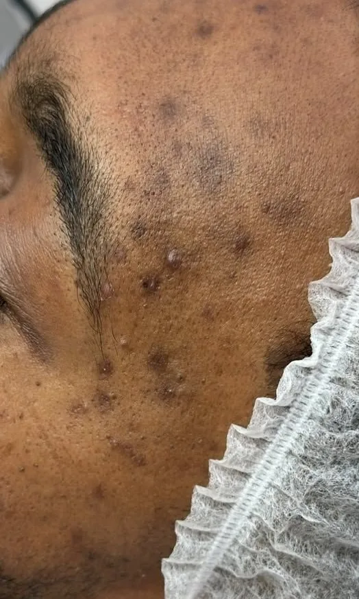 Tempe et joue d'un homme à la peau foncée marquées par des boutons d'acné et des taches avant le protocole anti-acné chez My Laser Casablanca