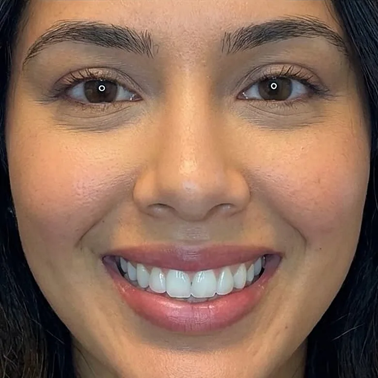 Sourire d'une patiente après l'injection de toxine botulique chez My Laser