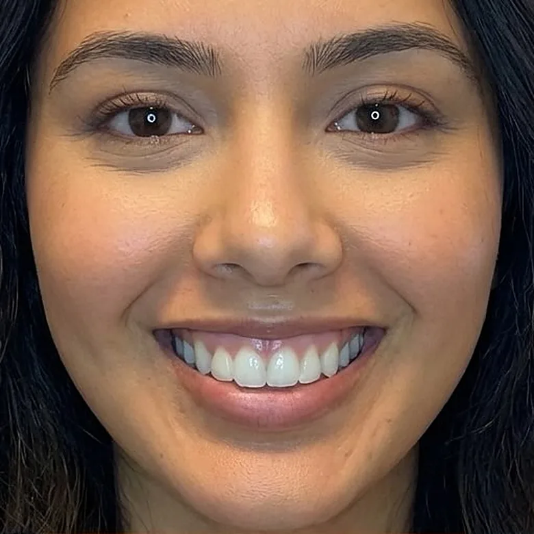 Sourire d'une patiente avant l'injection de toxine botulique chez My Laser