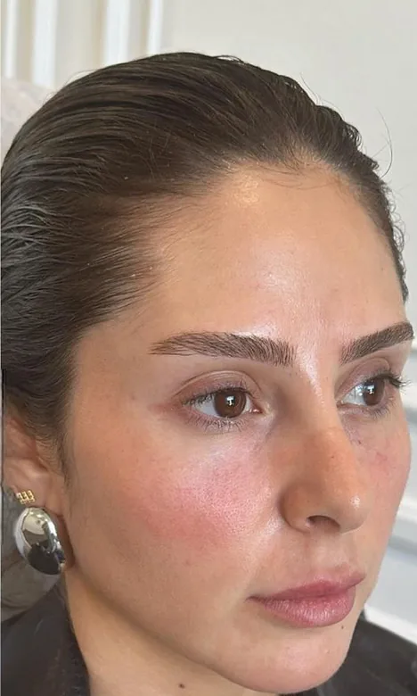 Regard reposé après l'injection d'acide hyaluronique des cernes chez My Laser Casablanca