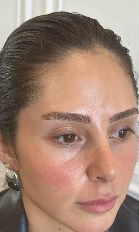 Cernes creux d'une patiente avant l'injection d'acide hyaluronique chez My Laser Casablanca