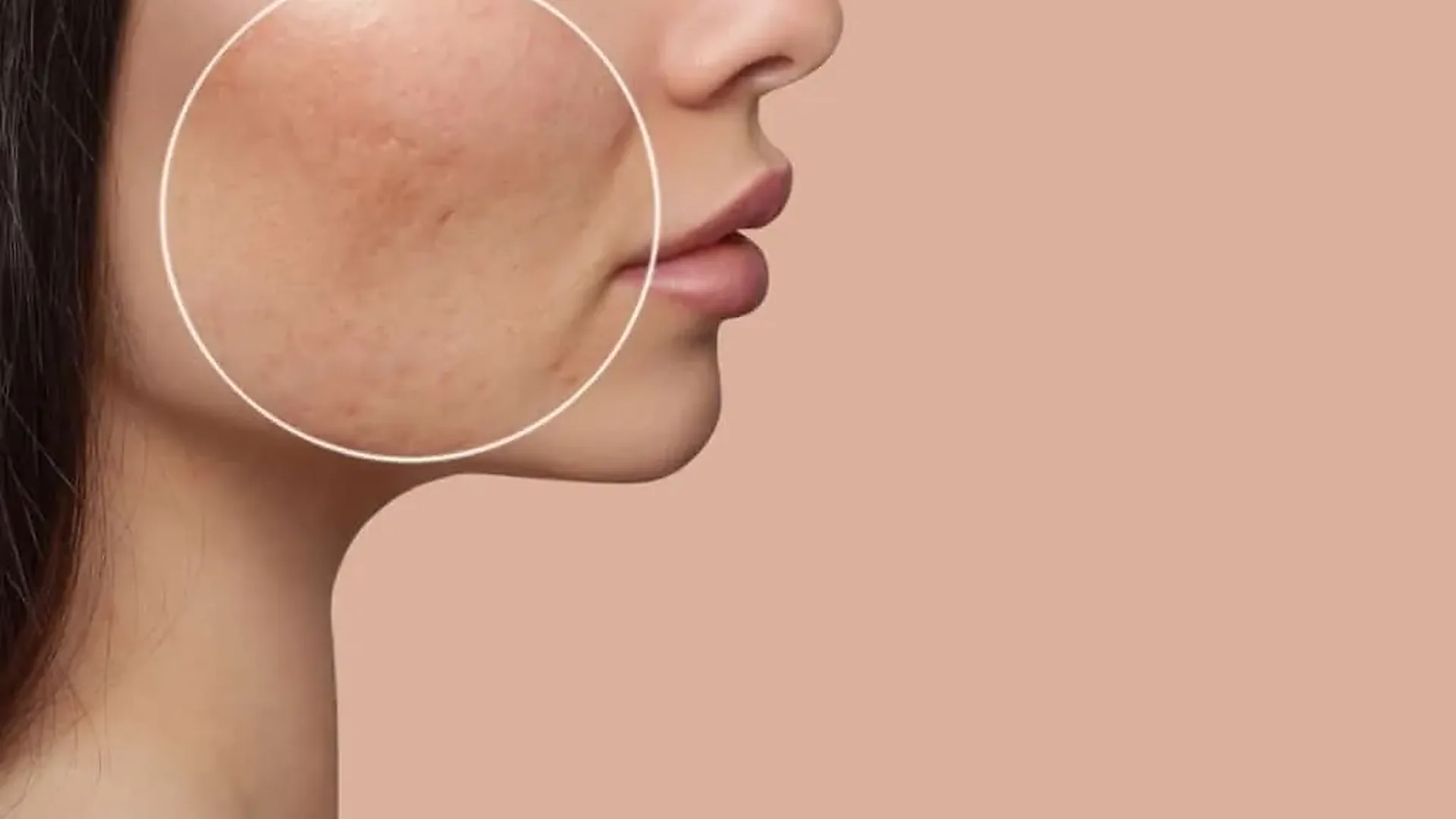 Joue d'une femme avec des cicatrices d'acné en creux, zone à traiter entourée