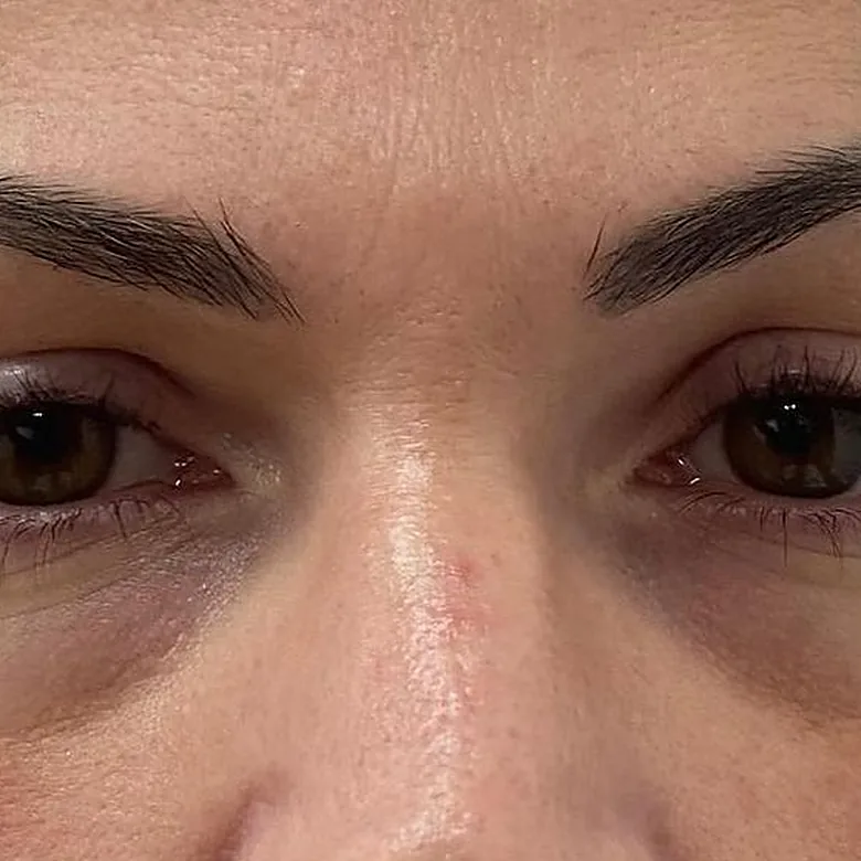Creux sous les yeux d'une patiente avant l'injection d'acide hyaluronique des cernes chez My Laser Maroc