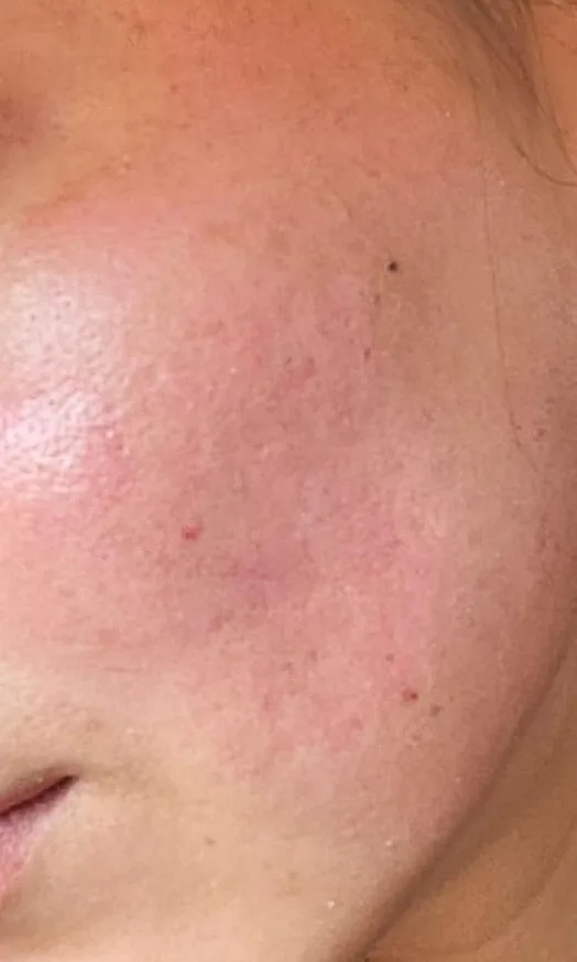 Joue au grain de peau lissé après le traitement des cicatrices chez My Laser Tanger