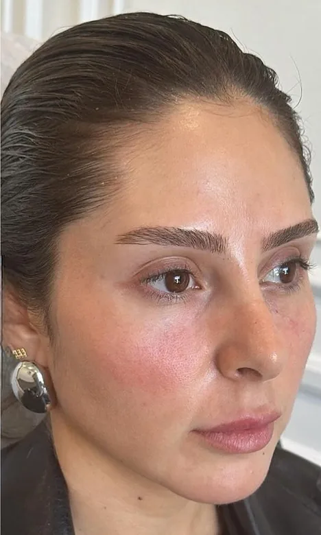 Cernes atténués après l'injection d'acide hyaluronique chez My Laser Maroc