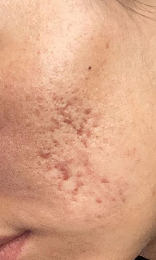 Joue avec des cicatrices d'acné en creux avant le traitement au Laser Frax chez My Laser Tanger