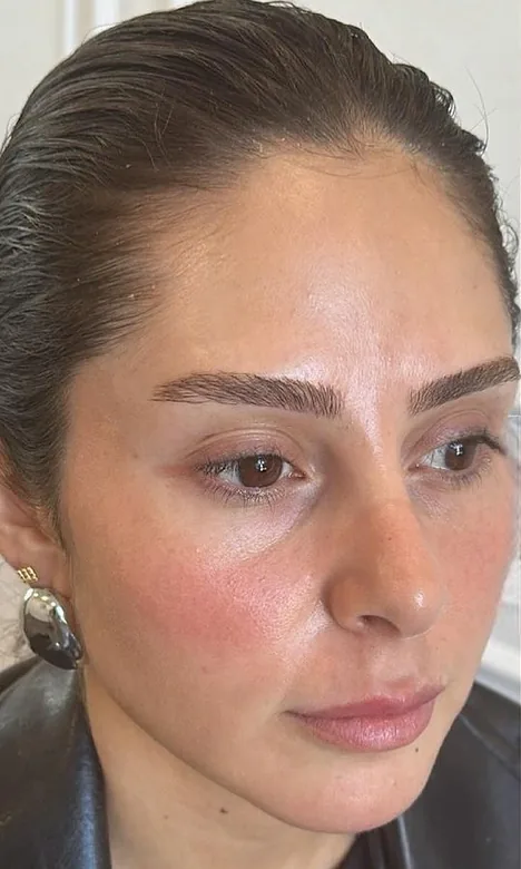 Cernes marqués d'une patiente avant l'injection d'acide hyaluronique chez My Laser Maroc