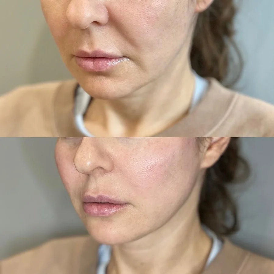 Bas du visage et cou d'une patiente après une séance d'Endolift chez My Laser Maroc