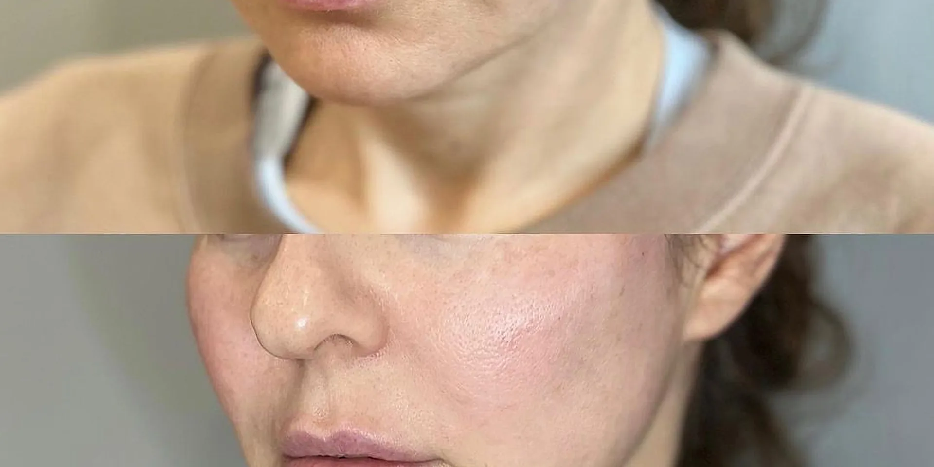 Bas du visage et cou d'une patiente avant et après une séance d'Endolift chez My Laser Maroc, ovale raffermi
