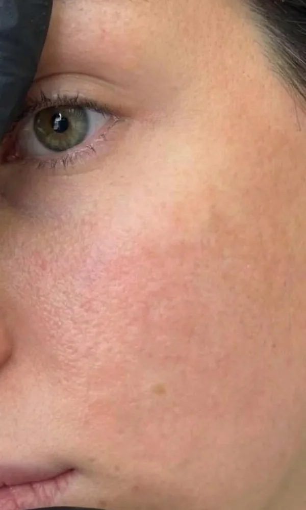 Joue au relief atténué après le Laser Frax chez My Laser Casablanca