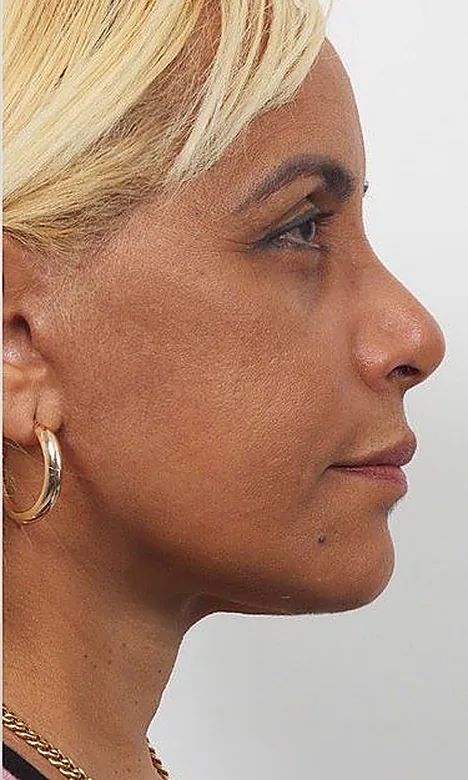 Profil d'une patiente après l'Endolift chez My Laser Maroc, ovale et cou retendus