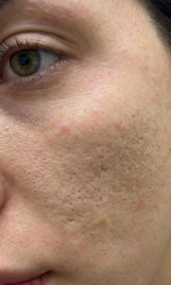 Joue d'une femme marquée par des cicatrices d'acné avant le Laser Frax chez My Laser Casablanca