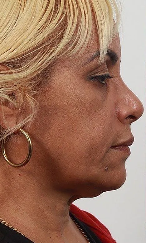 Profil d'une patiente avant l'Endolift chez My Laser Maroc, relâchement du bas du visage et du cou