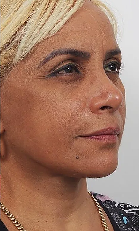 Visage de trois quarts d'une patiente après l'Endolift chez My Laser Maroc, contours plus nets