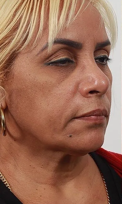 Visage de trois quarts d'une patiente avant l'Endolift chez My Laser Maroc