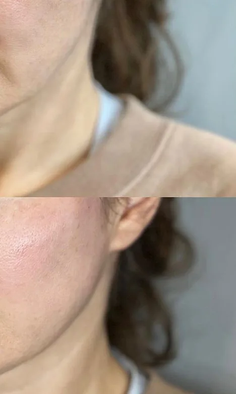 Ovale du visage et cou raffermis après la séance d'Endolift chez My Laser Maroc